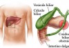 Pedra na Vesícula | Colelitíase – Saiba tudo a respeito